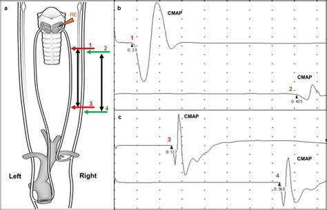 Schematic Of The Nerve Conduction Study A Approach To Determine