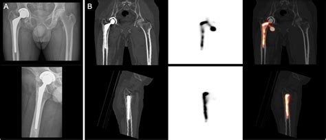Femoral Component Loosening Of A Right Hip Total Arthroplasty The