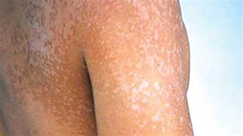 What To Know About Pityriasis Versicolor Skin Infection The