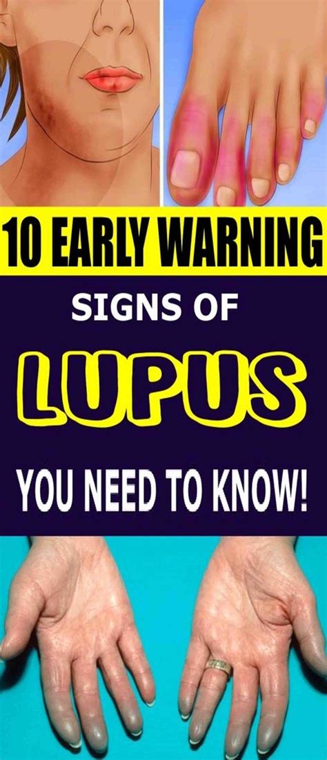 Early Warning Signs Of Lupus You Need To Know Wellness Magazine