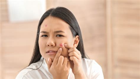 5 Best Home Remedies For Pimples That Are Completely Natural Healthshots