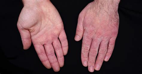 5 ways to treat your chapped hands | Nebraska Medicine ...