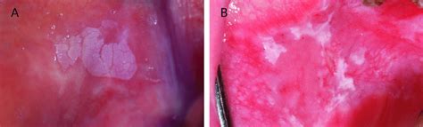 Clinical Presentation Of Homogeneous Leukoplakia A And Download