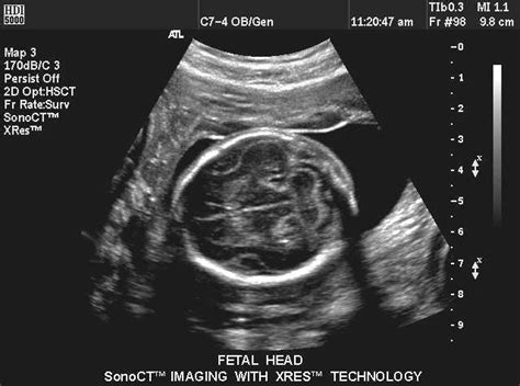 Normal Fetal Brain Ultrasound Anatomy