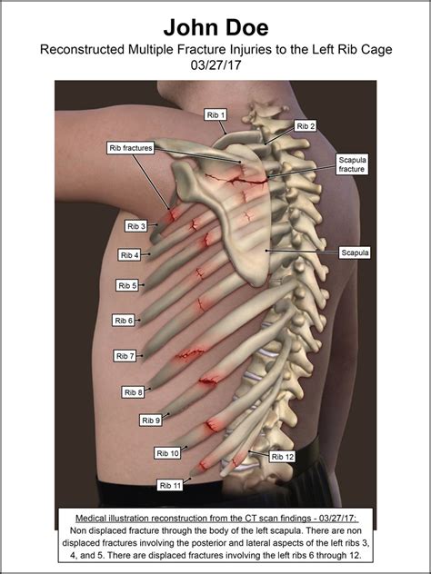 Rib Cage Fractures Illustration By Visuals For Law Medical Illustration And Animation
