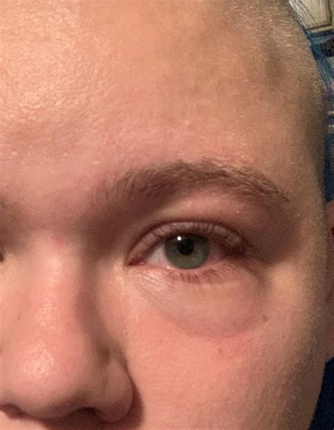 My Eye Has Been Swelling Up For Hours And I Dont Know Why Cant Make
