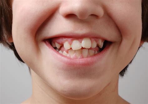 How To Avoid Crooked Teeth With Early Intervention And Habit Correction