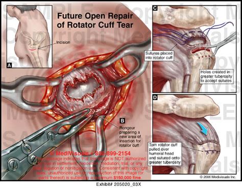B gives information about how is a torn rotator cuff repaired. Future Open Repair of Rotator Cuff Tear Medical ...