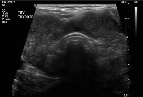 Ultrasound Of Thyroid Gland
