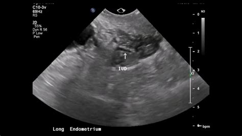 Transvaginal Ultrasound Iud In Myometrium Youtube