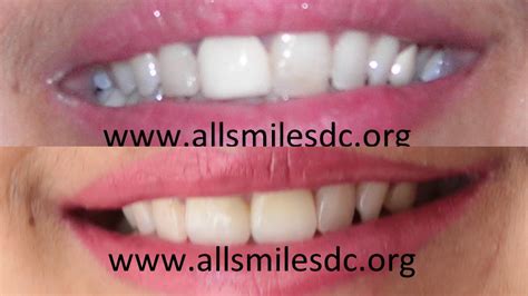 Smile Makeovers By Expert Cosmetic Dentist In Bangalorecosmetic