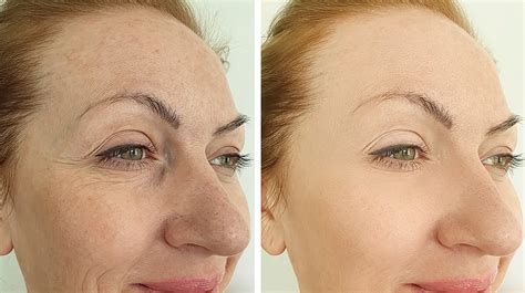 Chemical Peel Treatment In Los Angeles Eyesthetica