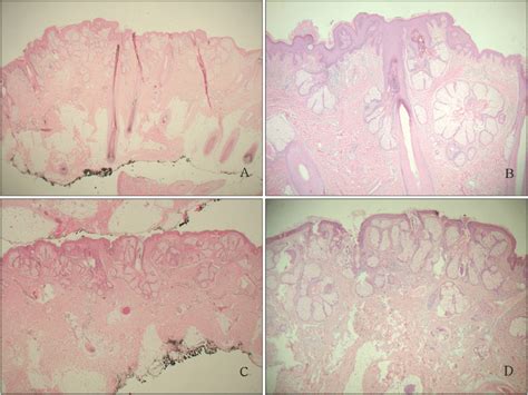 Hyperplastic And Hypertrophic Sebaceous Glands And Papillomatous
