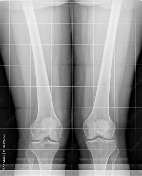 Two Knees With A Genu Valgum X Ray Scan Radiograph Examination Stock