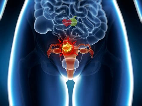 Imagens Do Colo Do Utero Com Cancer