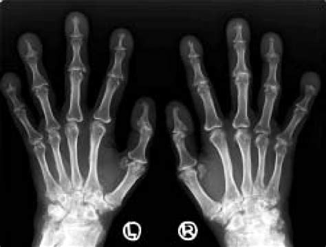 Anteroposterior Radiograph Of Both Hands Shows Enlargement Of The