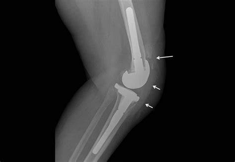 Диета перед эндопротезированием коленного сустава - фото презентация Картинка - Диета перед эндопротезированием коленного сустава - фото презентация