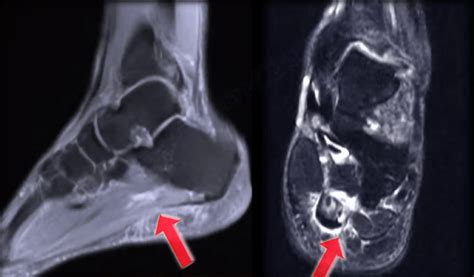 Rupture Of The Plantar Fascia Orthopedic Surgery Foot