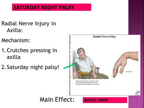 Saturday Night Palsy Radial Nerve Nerve Palsy Anatomy