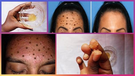 Get Rid Of Forehead Blackheads Easy And Effective Youtube