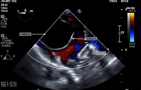 Cureus Atrial Septal Aneurysm An Incidental Finding Or A Clinically