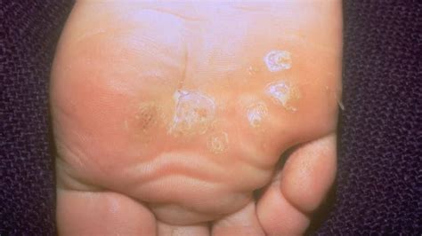 Painful White Spot On Bottom Of Foot Red Rash On Bottom Of Feet