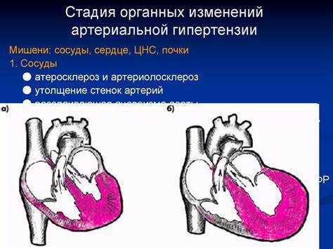 Диета при ишемии миокарда Патофизиология ишемии миокарда. Патофизиология артериальной гипертензии Патофизиология ишемии миокарда. Патофизиология артериальной гипертензии Диета при ишемии миокарда