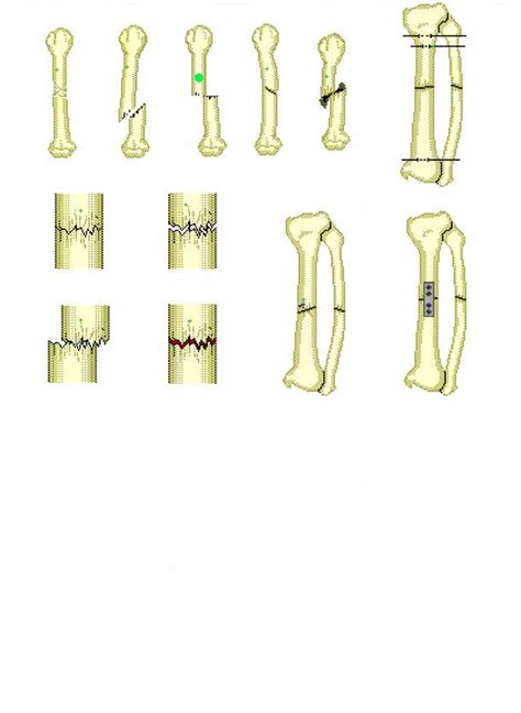 Transverse Fractures Causes Realignment Treatment