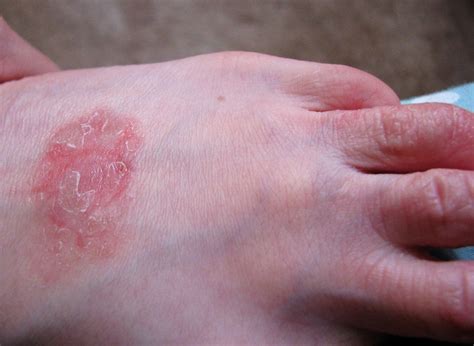 Quick Tips On How To Treat Eczema Scars London Tv
