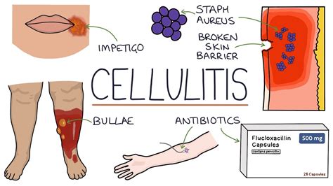 Download Understanding Cellulitis Skin And Soft Tissue Infections Waploadeds