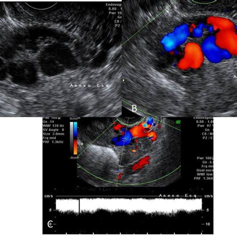 Maybe you would like to learn more about one of these? Leiomyoma on MRI. Pelvic MRI, axial T1 (A) and sagittal T2 ...