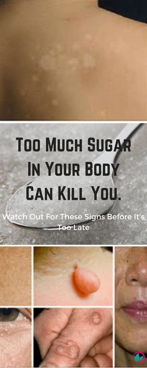 Too Much Sugar In Your Body Can Kill You Watch Out For These Signs Before It’s Too Late Sugar