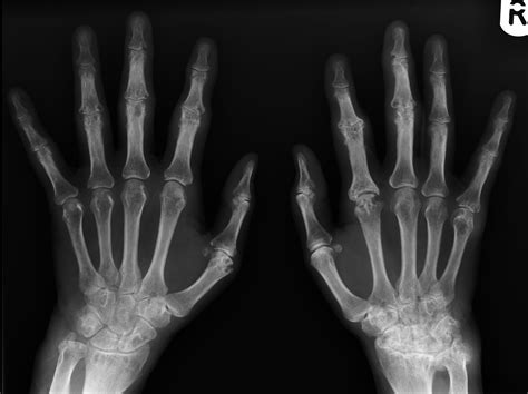 Rheumatoid Arthritis Hands Image