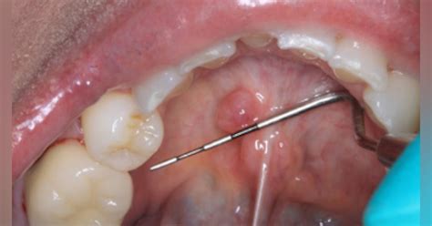 Diagnosis And Treatment For Breakthrough Clinical Oral Pathology Case