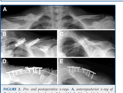 Figure 2 From Brachial Plexus Compression Caused By Recurrent