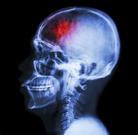 Tbi 101 About Traumatic Brain Injury Brainline