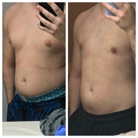 5 Months Post Op And Also Lost Around 13 Pounds R Gynecomastia