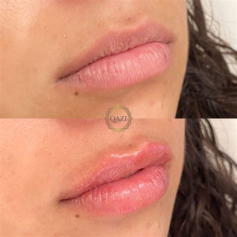 Lip Fillers In Orange County CA Qazi Cosmetic Center