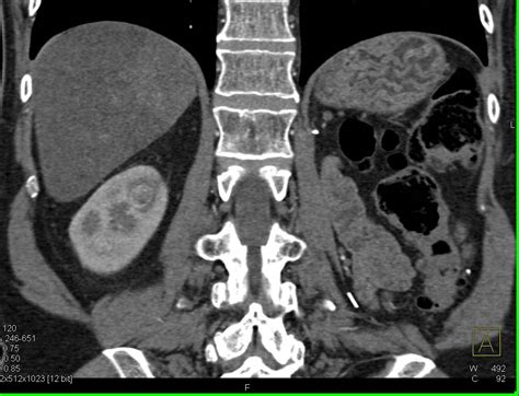 Renal Cell Carcinoma Metastatic To The Contralateral Adrenal Adrenal
