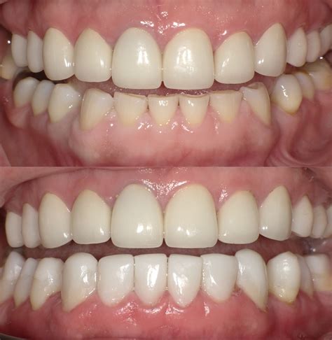 Do You Have Worn Or Broken Lower Teeth These Teeth Were Restored With The Bioclear Method Zero