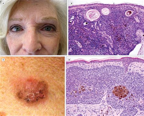 Pigmented Basal Cell Carcinoma Uncommon Presentation In Blue Eyed