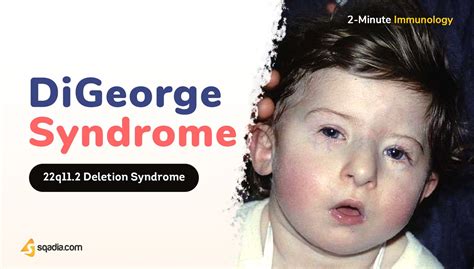 Minute Immunology Digeorge Syndrome