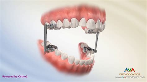 Orthodontic Treatment For Overjet Overbite Advancesync Appliance