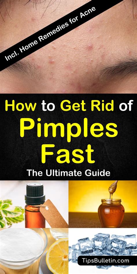 how to remove pimples naturally