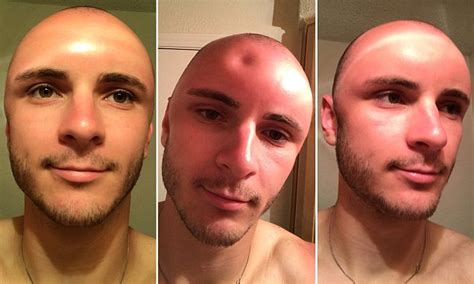 Man Sunburned So Badly He Poked A Dent In His Forehead Daily Mail Online