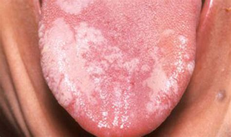 Cancer Symptoms Mouth Tumour Signs Include White Spots Leukoplakia