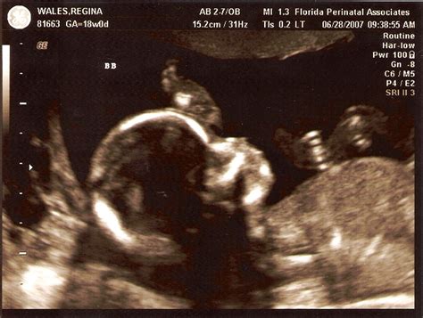 More Ultrasounds Of The Twins