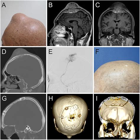Frontiers Technical Case Report Of A Cranioplasty With Ex Vivo Frozen