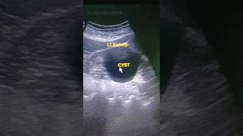 Lt Renal Cortical Cyst In Ultrasound Ll Big Renal Cyst Ll Kidney Cyst