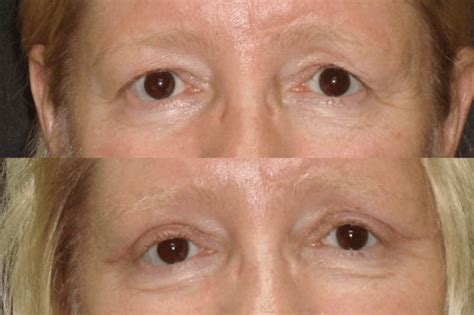 Eyelid Surgery Tampa Elite Facial Plastic Surgery